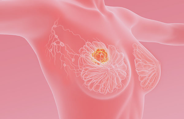 Breast cancer with lymphatics